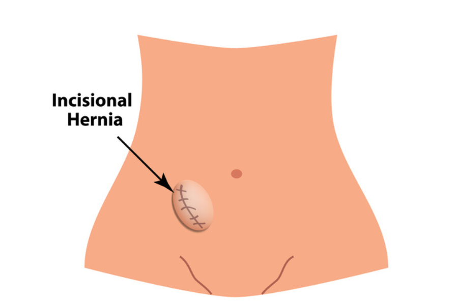 Μετεγχειρητική κήλη