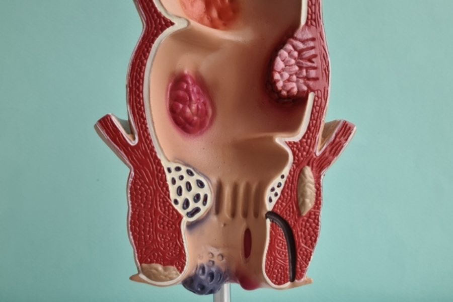 Ραγάδα δακτυλίου