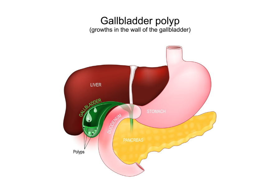 πολύποδες στη χολή